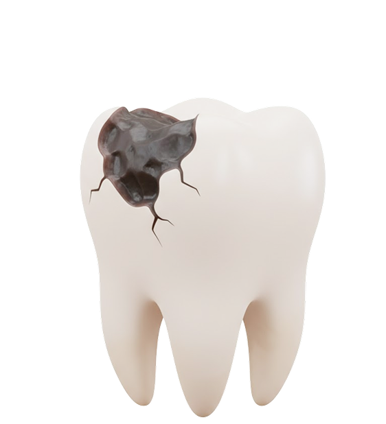 Лечение кариеса <strong>без сверления (ICON)</strong>