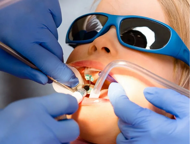 Удаление кариеса (ICON)