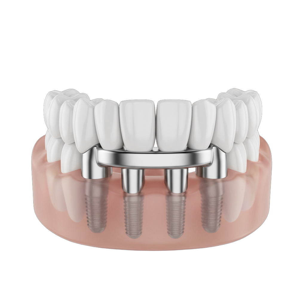 
        Восстановление зубов <strong>по методике All-on-4</strong>